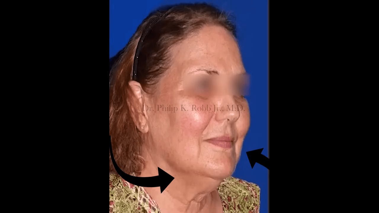 Robb Facial Plastic Surgery