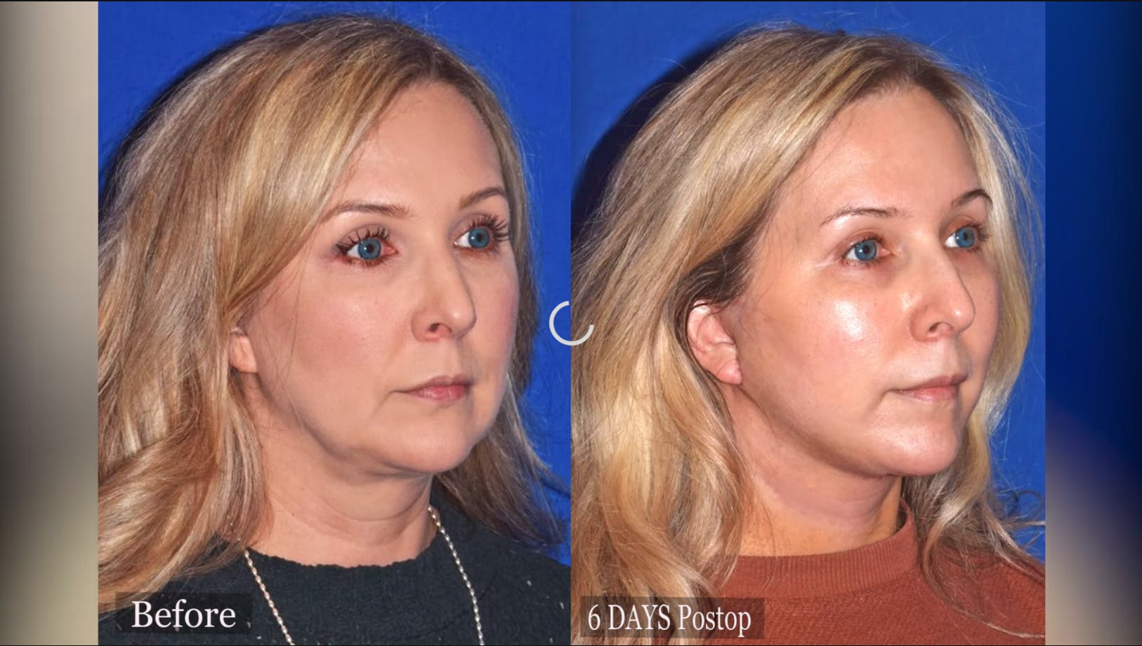 Robb Facial Plastic Surgery