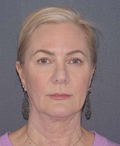 Face Before & After Gallery - Patient 63980132 - Image 1