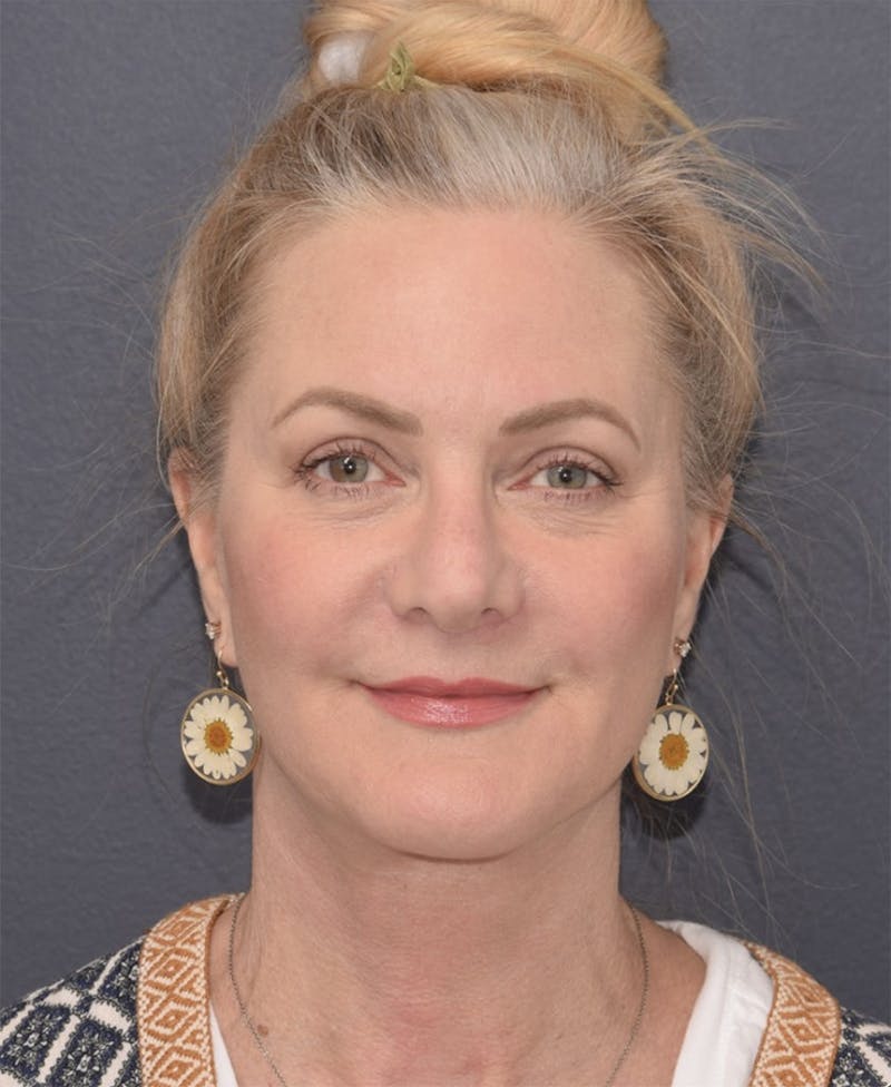 Face Before & After Gallery - Patient 63980132 - Image 2