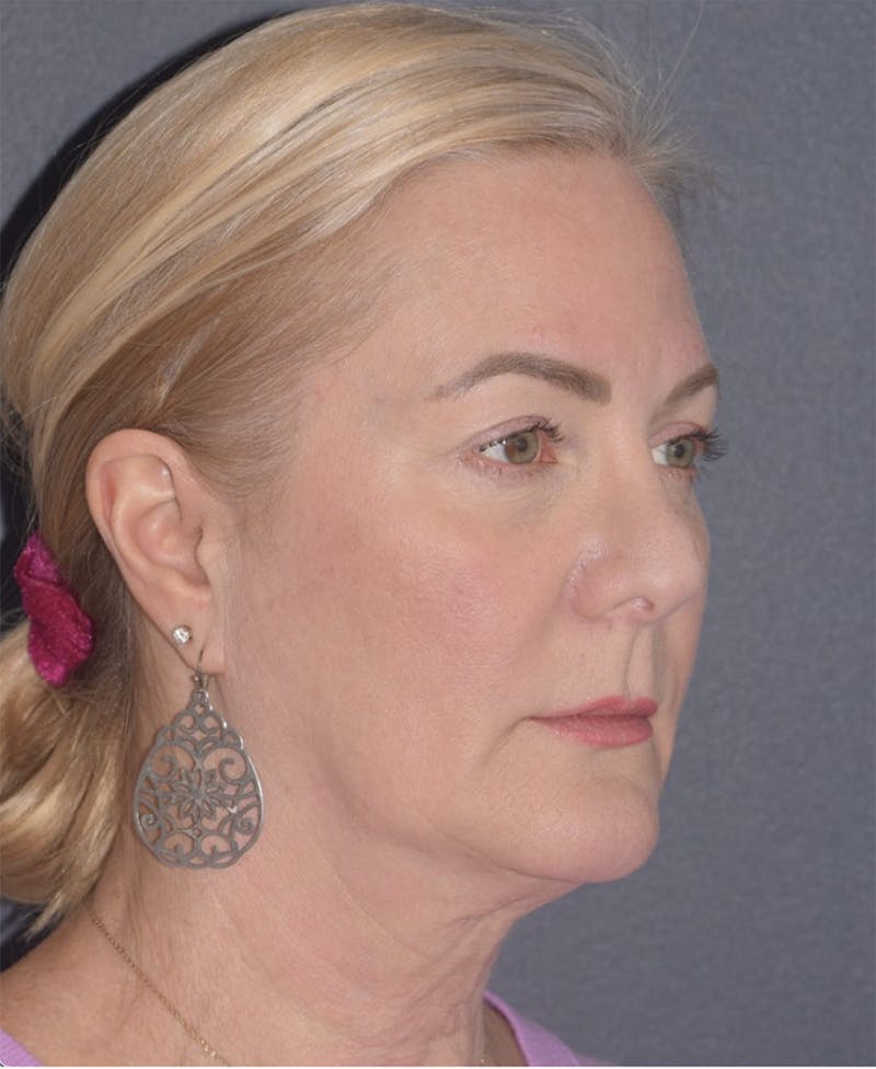 Face Before & After Gallery - Patient 63980132 - Image 3