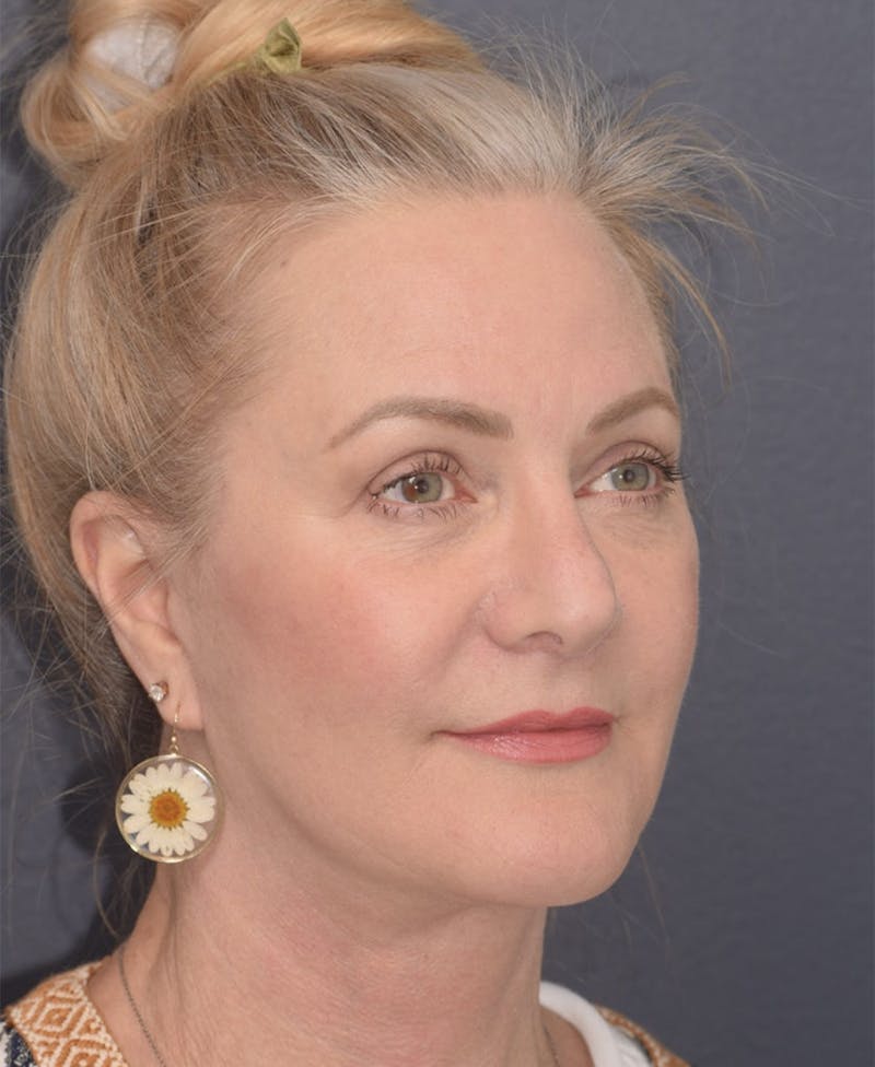 Face Before & After Gallery - Patient 63980132 - Image 4