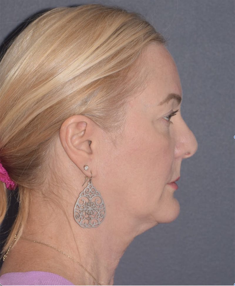 Face Before & After Gallery - Patient 63980132 - Image 5