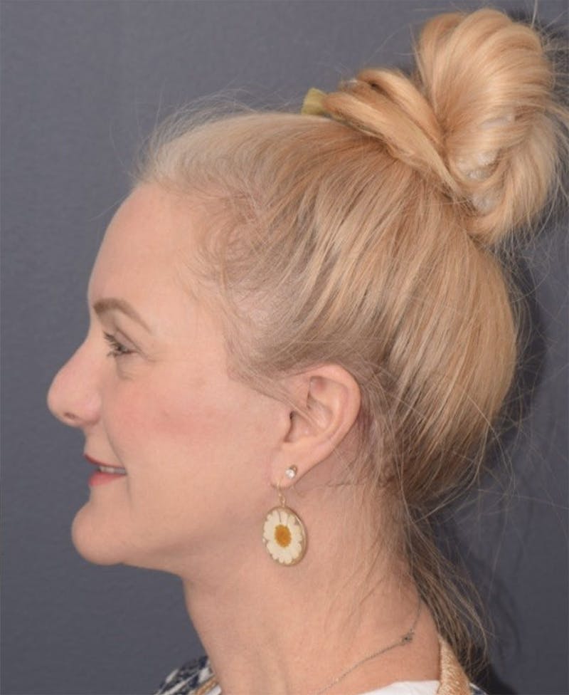 Face Before & After Gallery - Patient 63980132 - Image 10