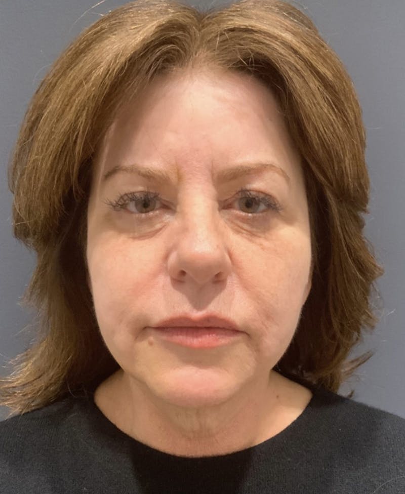 Face Before & After Gallery - Patient 63980133 - Image 1