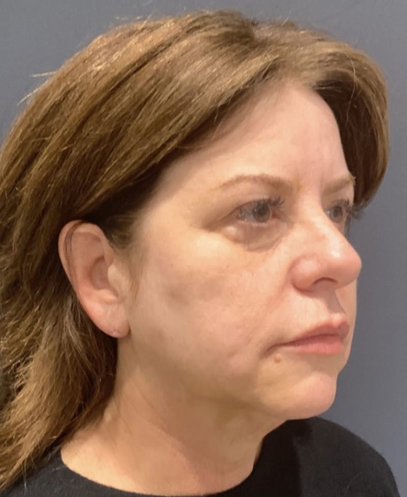 Face Before & After Gallery - Patient 63980133 - Image 3
