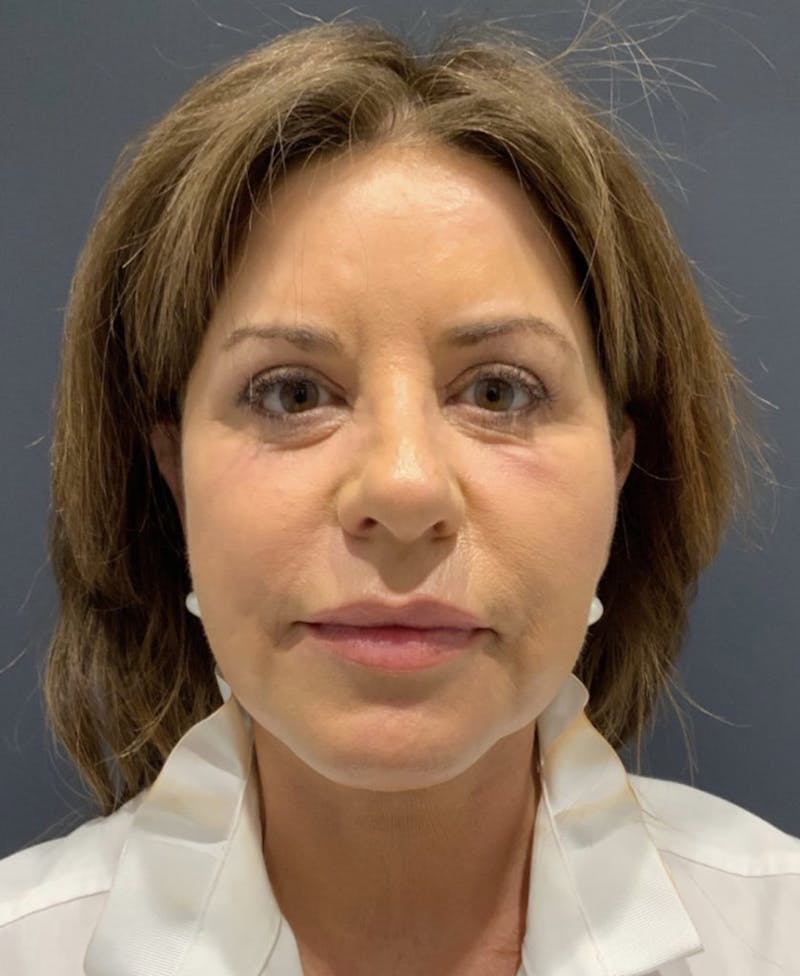Face Before & After Gallery - Patient 63980133 - Image 2