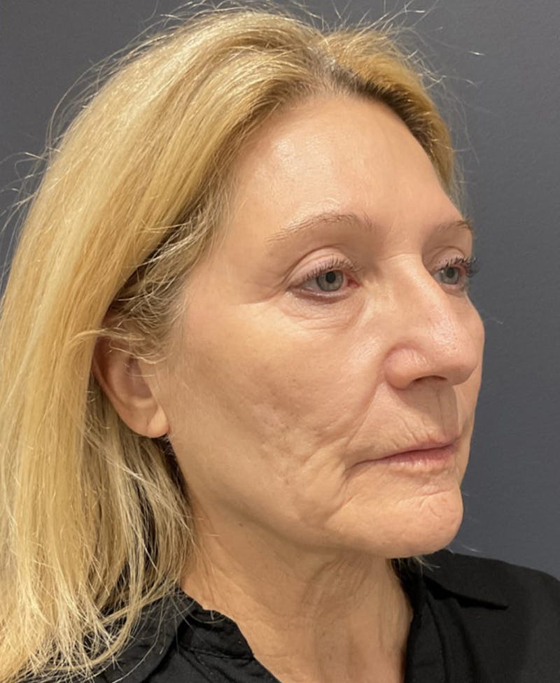 Cosmetic Surgical Before & After Gallery - Patient 63980129 - Image 3