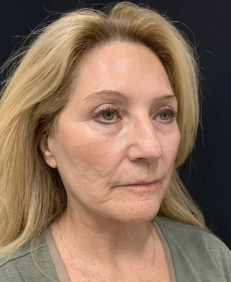 Face Before & After Gallery - Patient 63980129 - Image 4