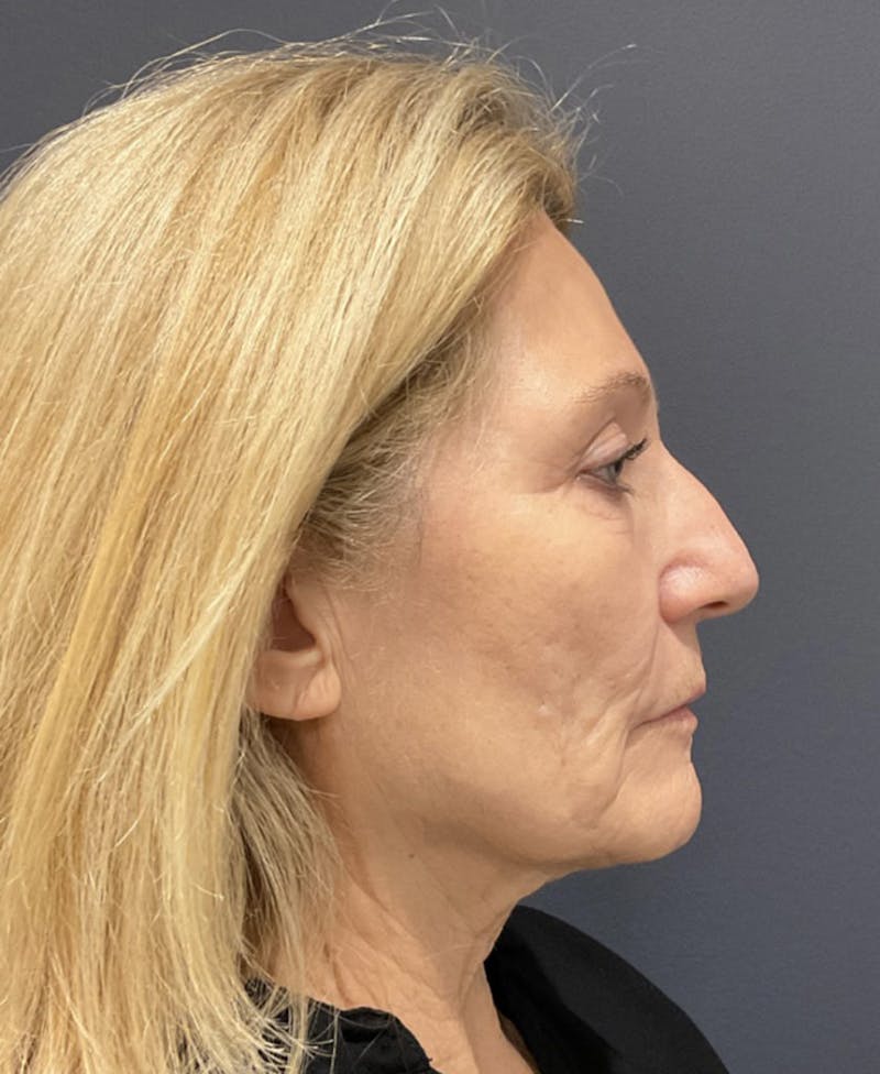 Face Before & After Gallery - Patient 63980129 - Image 5