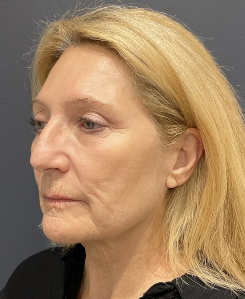 Face Before & After Gallery - Patient 63980129 - Image 7