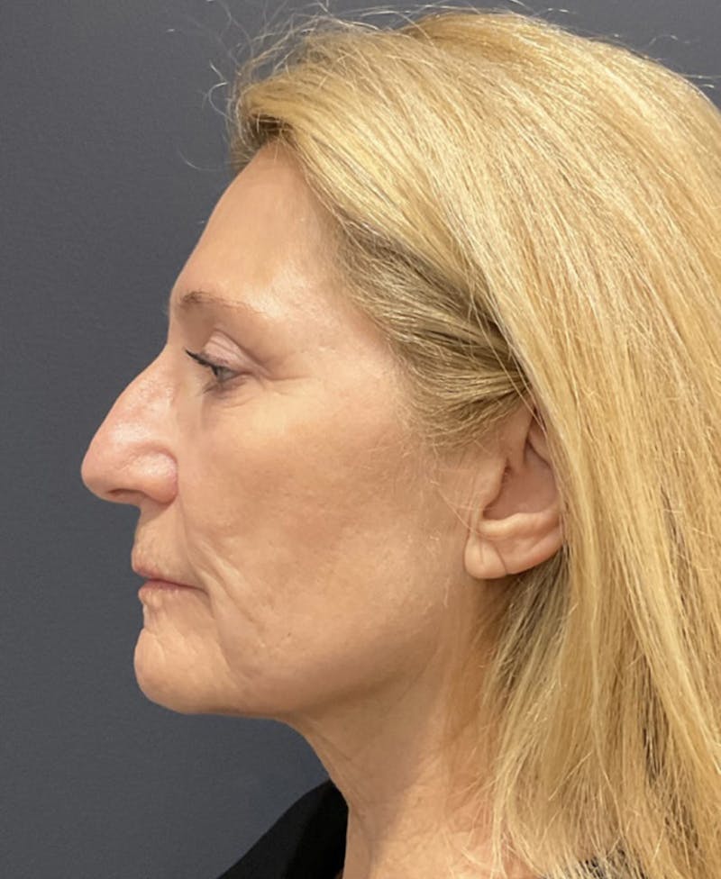 Face Before & After Gallery - Patient 63980129 - Image 9