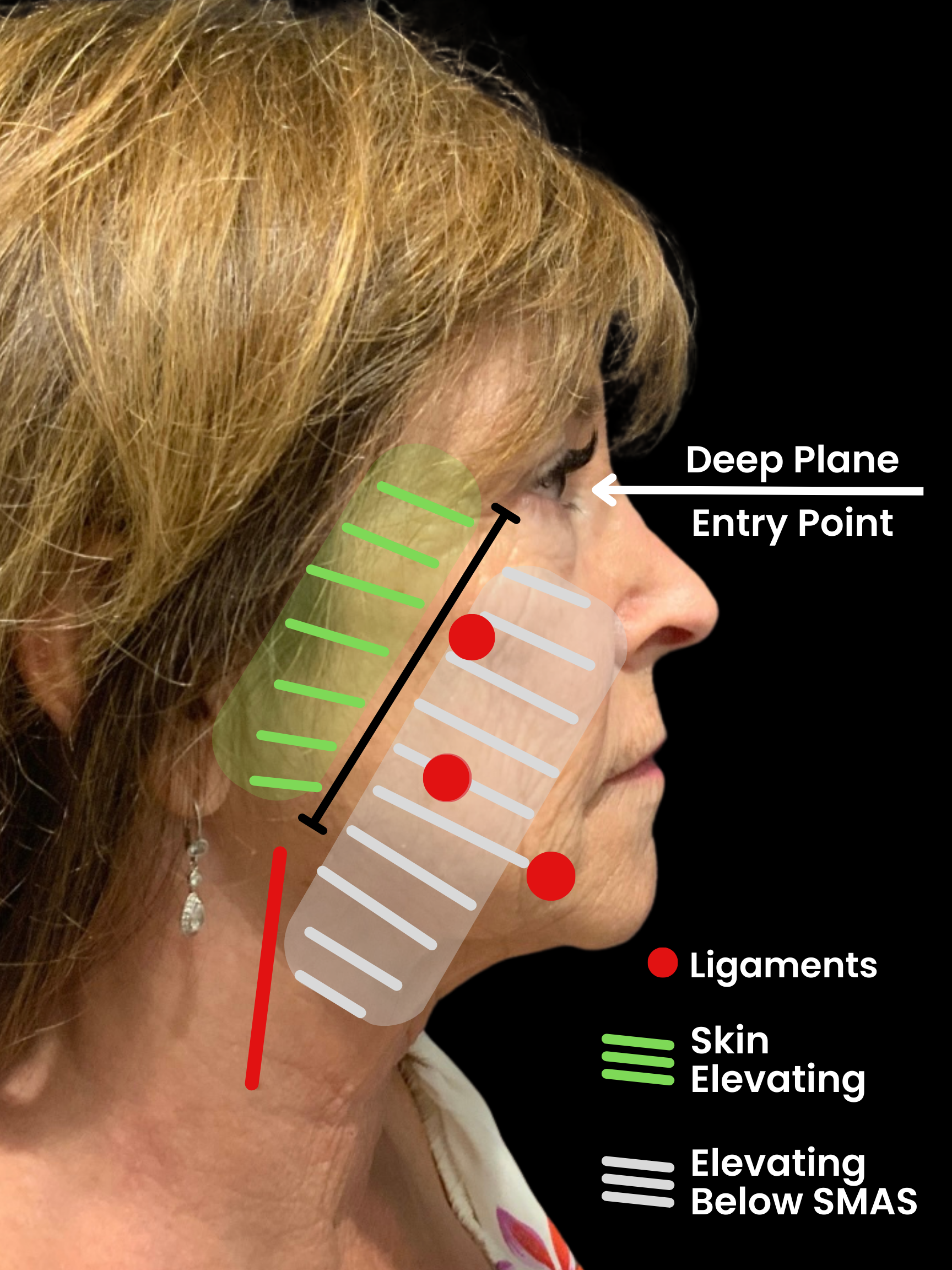 a diagram draw on a patients face to show what happens to the skin during a facelift