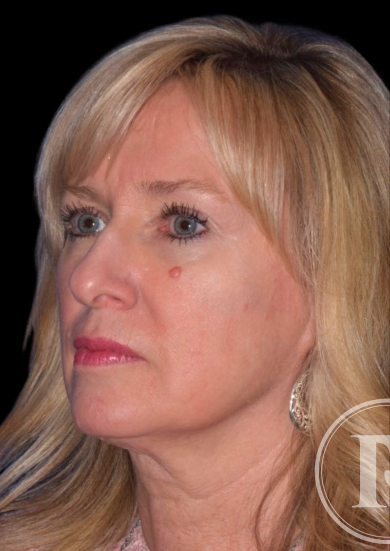 Face Before & After Gallery - Patient 92298618 - Image 3