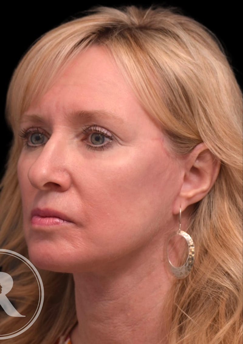 Face Before & After Gallery - Patient 92298618 - Image 4