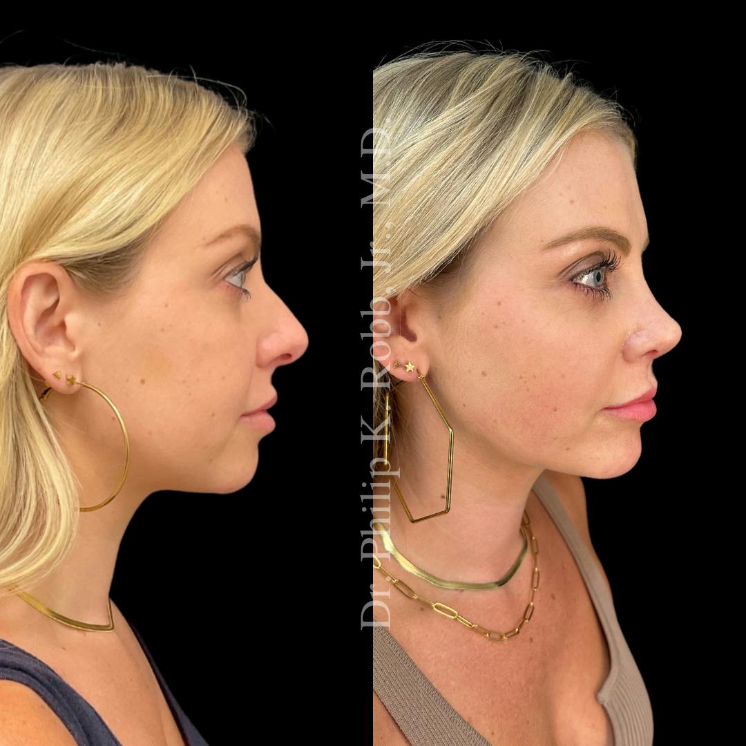 Face Before & After Gallery - Patient 178846046 - Image 5