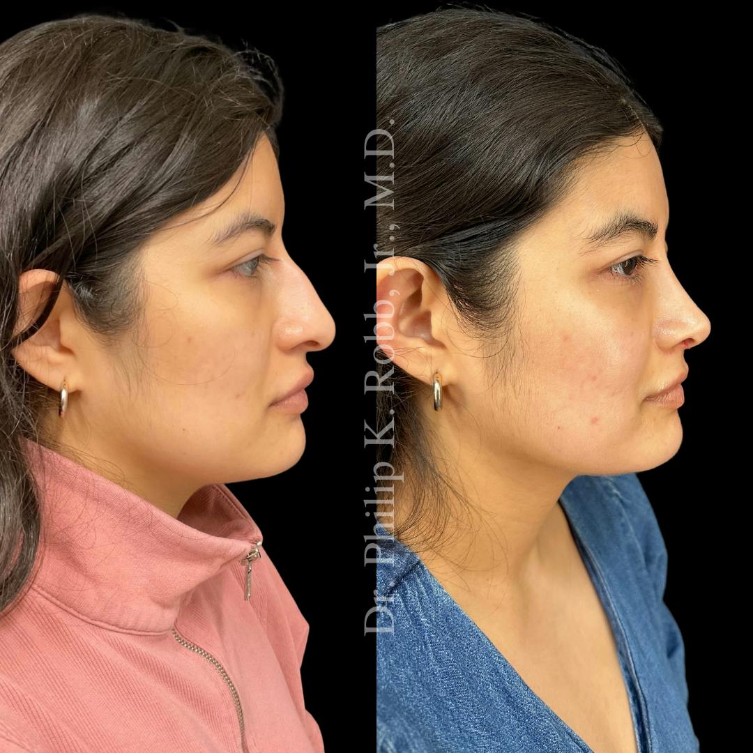 Face Before & After Gallery - Patient 178846067 - Image 3