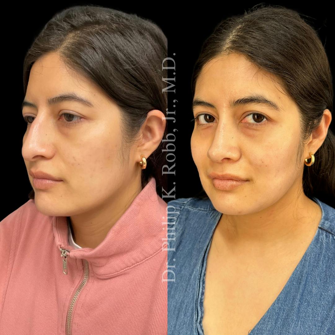Face Before & After Gallery - Patient 178846067 - Image 4