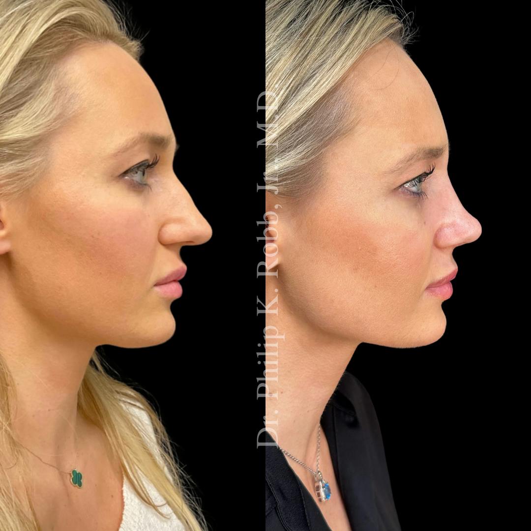 Face Before & After Gallery - Patient 178846069 - Image 3