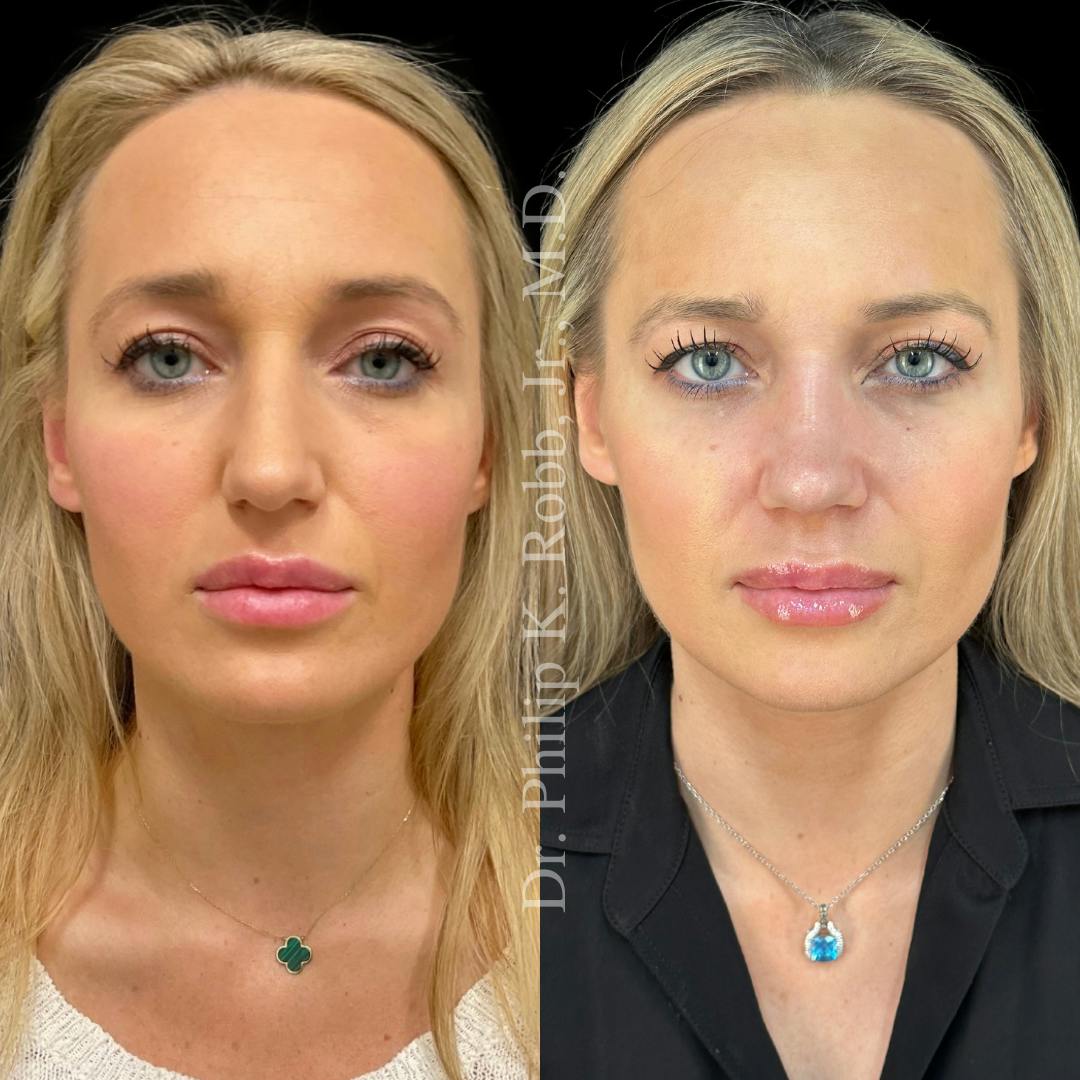 Face Before & After Gallery - Patient 178846069 - Image 1