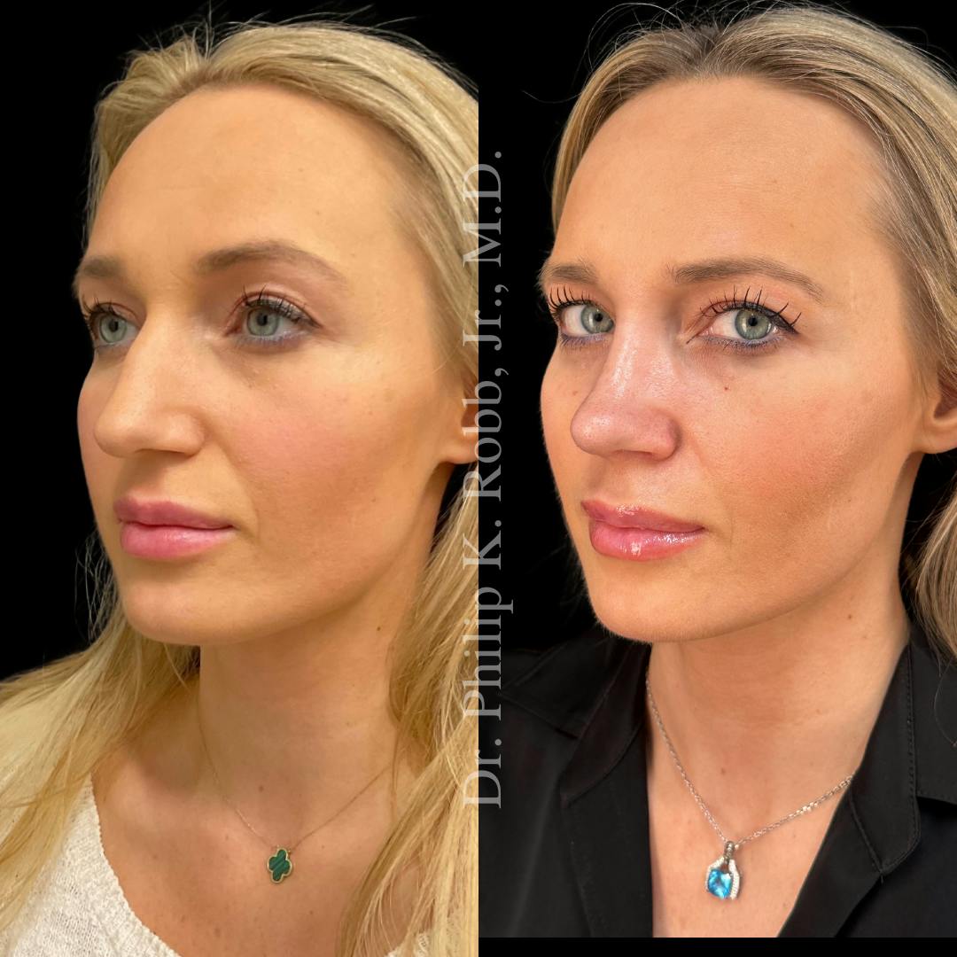 Face Before & After Gallery - Patient 178846069 - Image 4