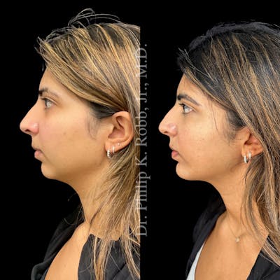 Face Before & After Gallery - Patient 178846073 - Image 1