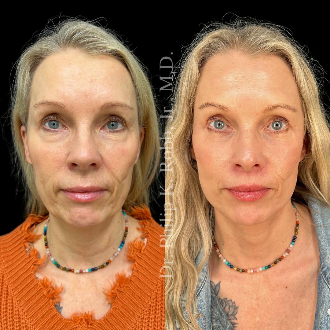 Face Before & After Gallery - Patient 178846078 - Image 1