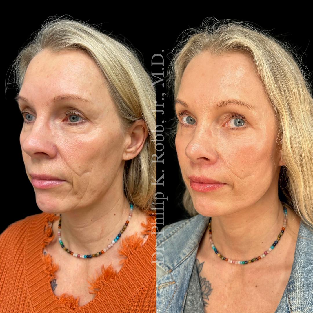 Face Before & After Gallery - Patient 178846078 - Image 5