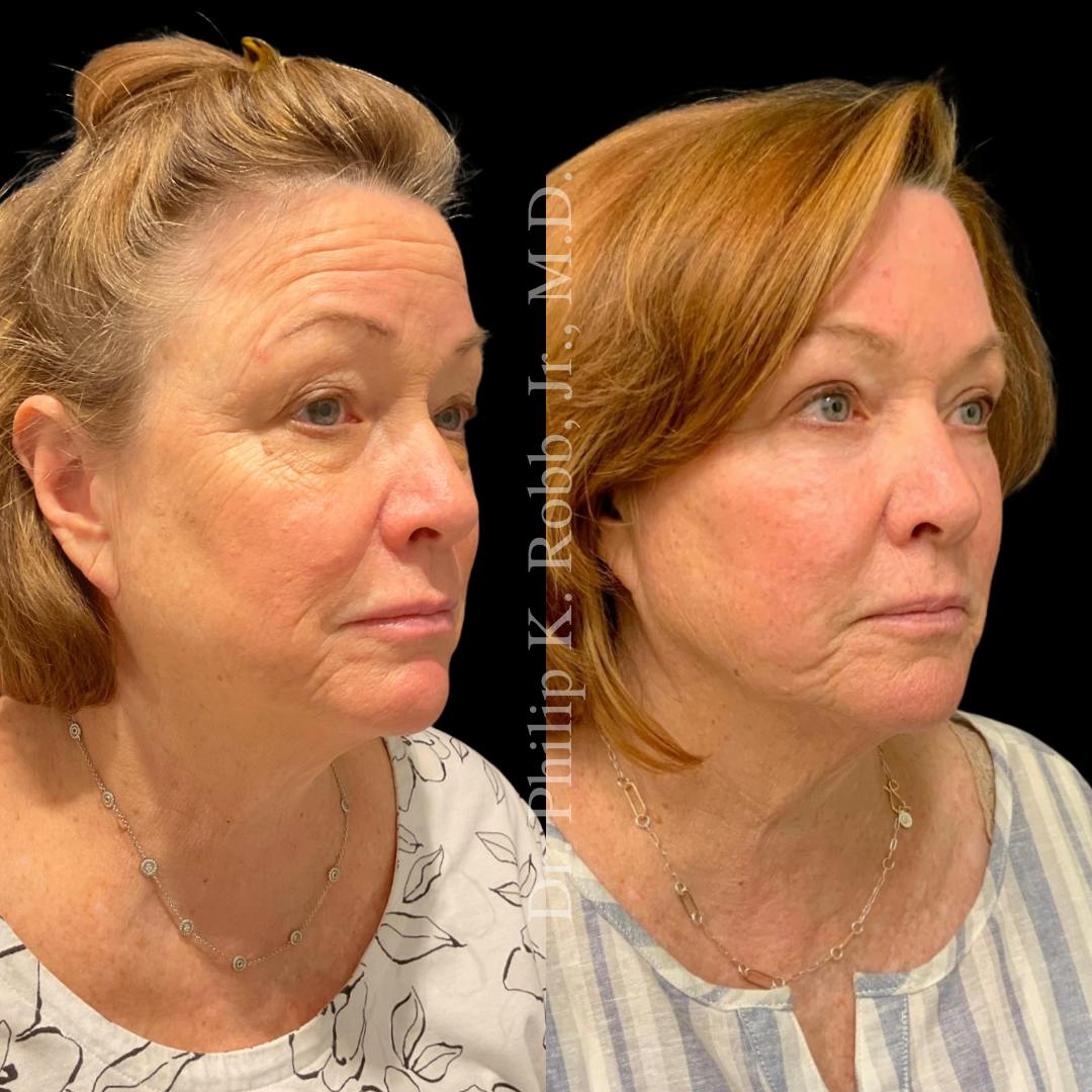 Face Before & After Gallery - Patient 178846077 - Image 2