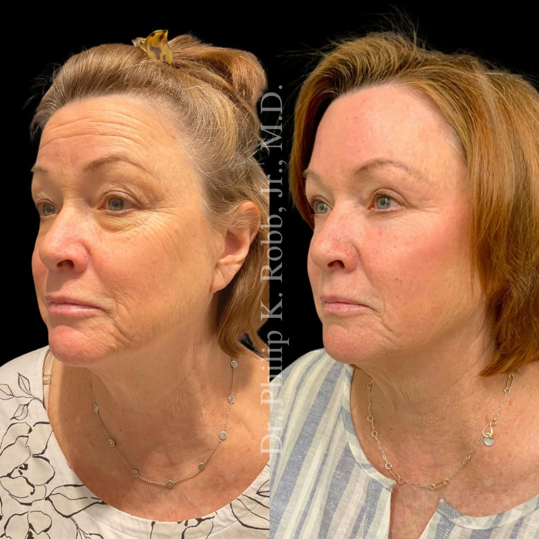 Face Before & After Gallery - Patient 178846077 - Image 3