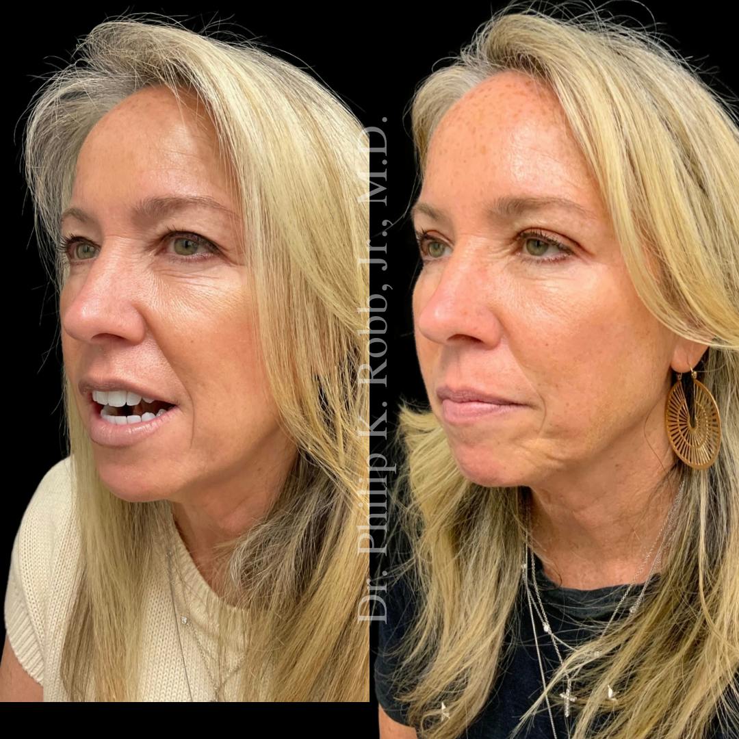 Face Before & After Gallery - Patient 178846080 - Image 1