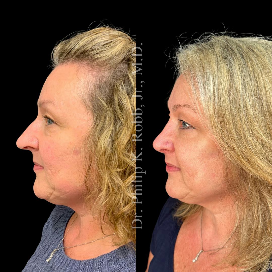 Face Before & After Gallery - Patient 178846091 - Image 5