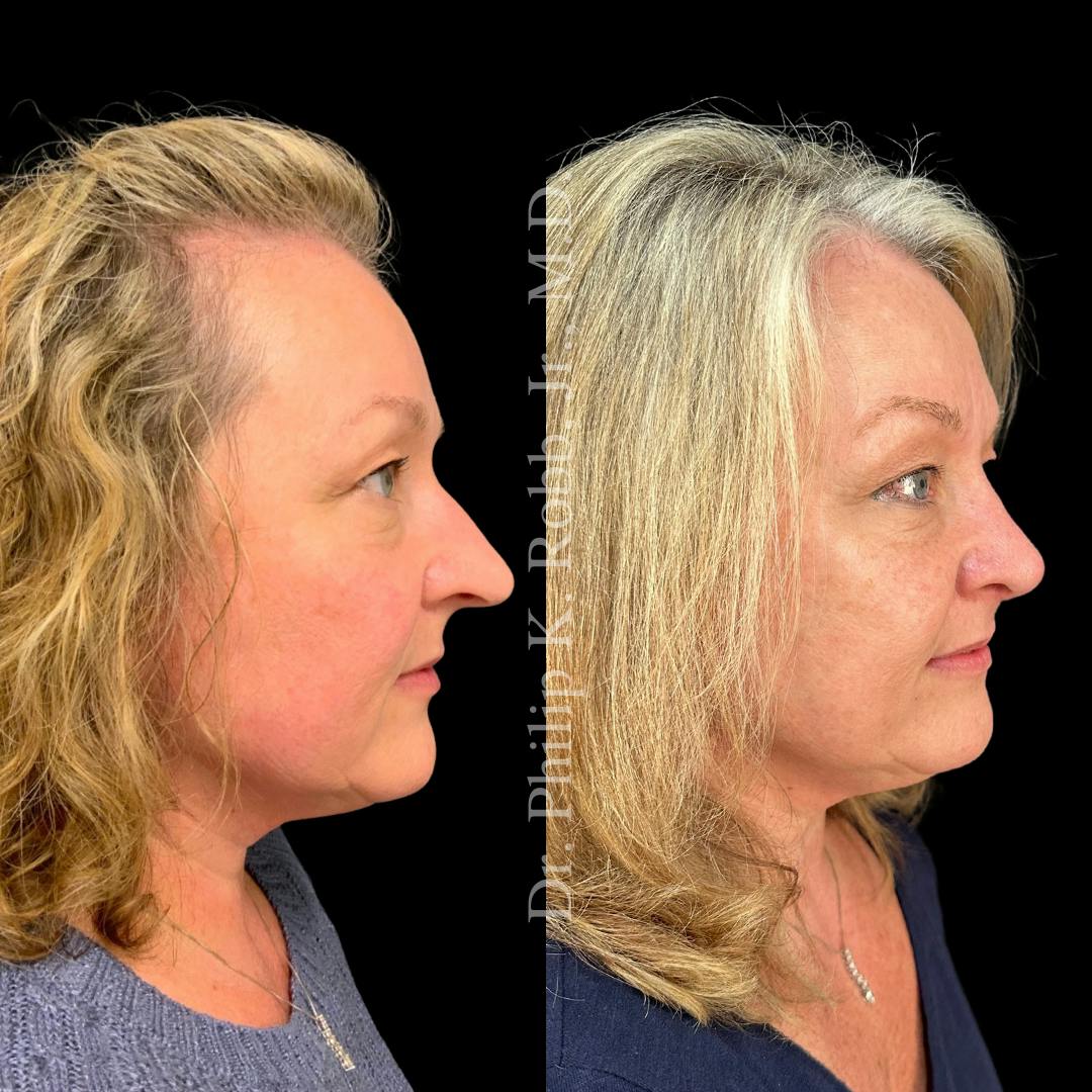 Face Before & After Gallery - Patient 178846091 - Image 3