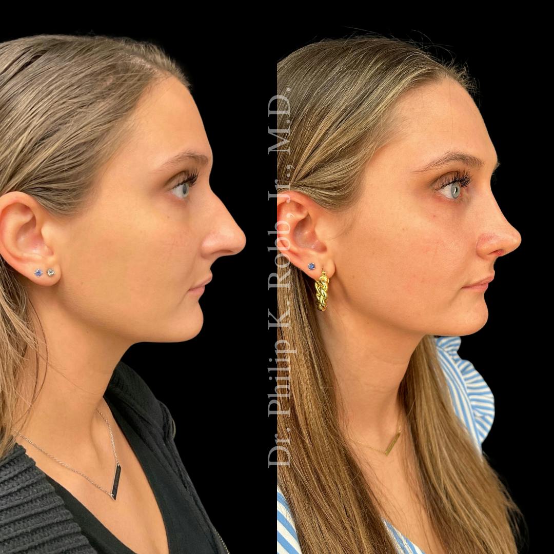 Face Before & After Gallery - Patient 178846098 - Image 3