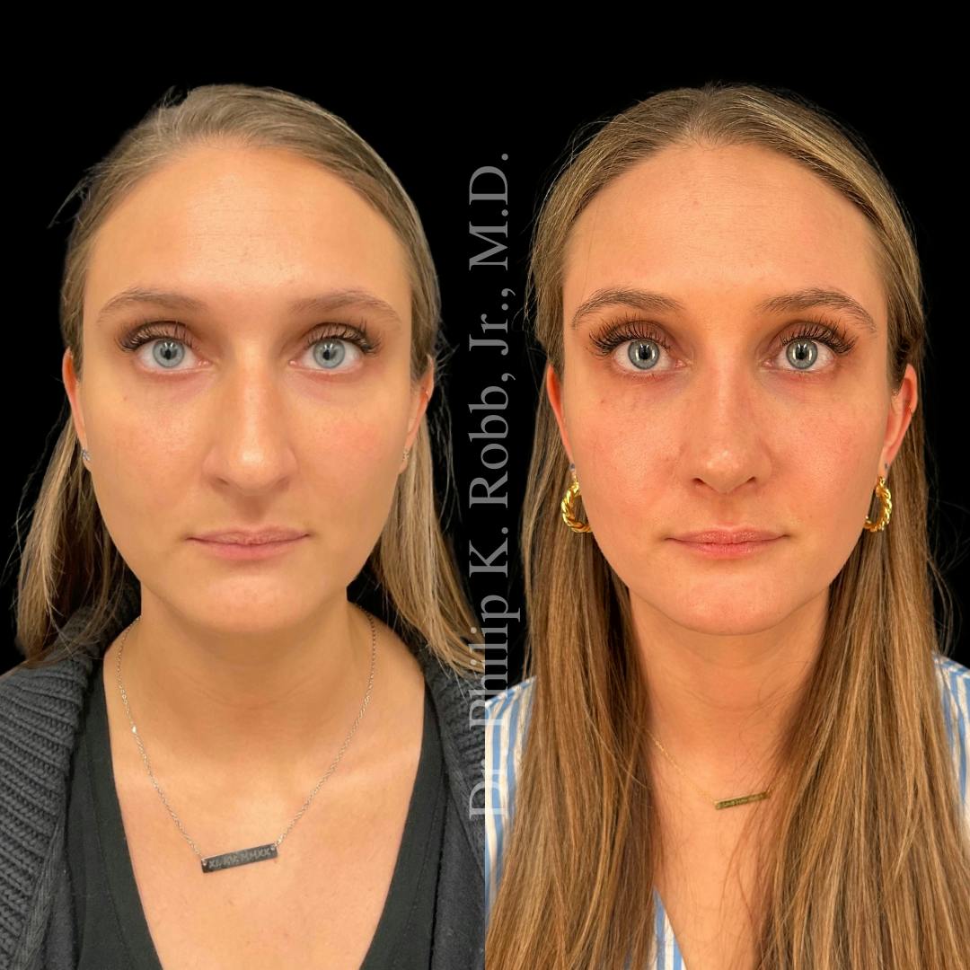Nose Before & After Gallery - Patient 189960478 - Image 2