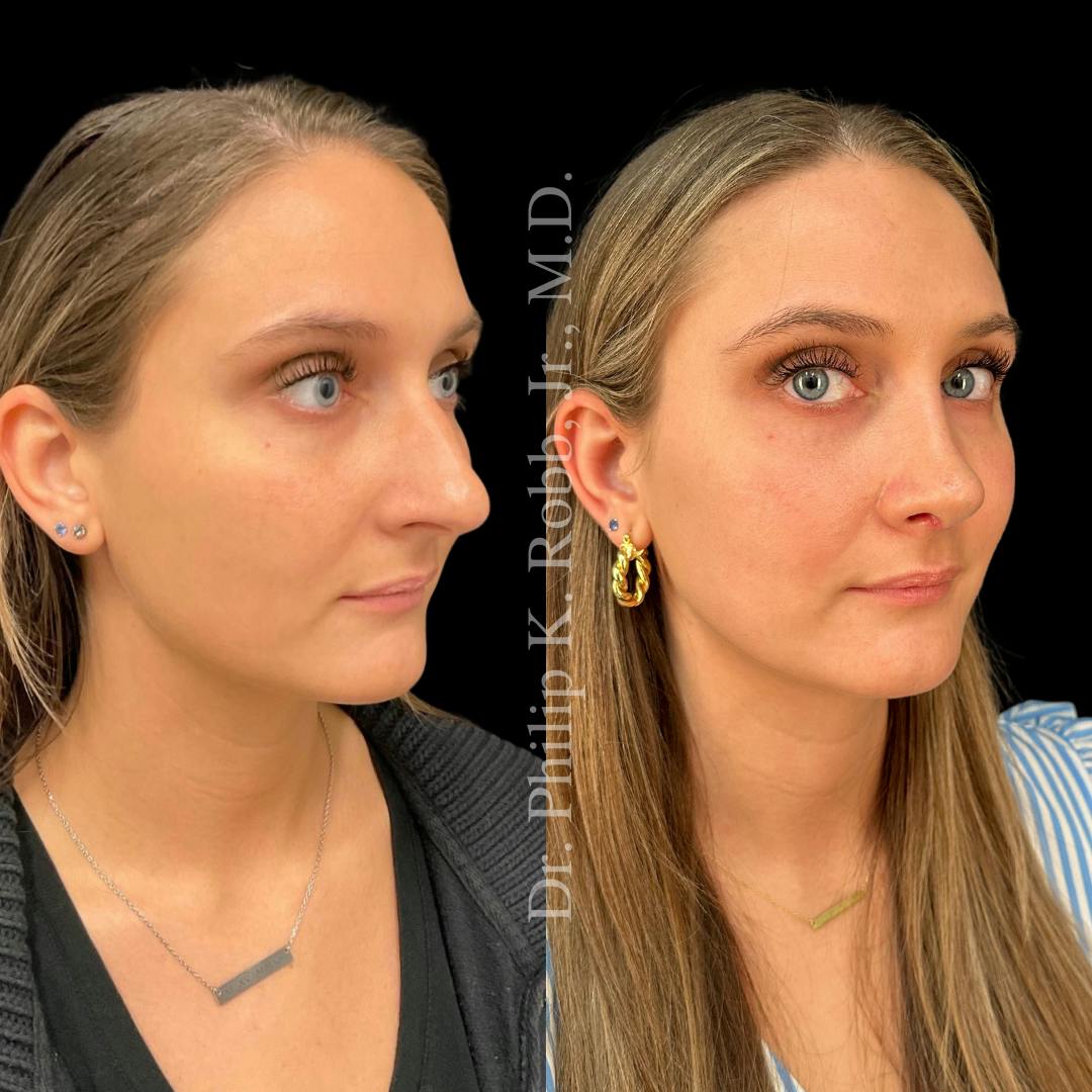 Nose Before & After Gallery - Patient 189960478 - Image 3