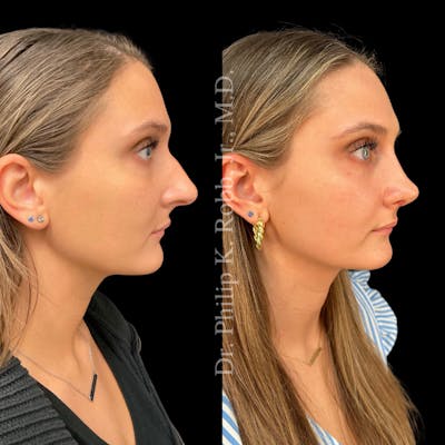 Nose Before & After Gallery - Patient 189960478 - Image 1