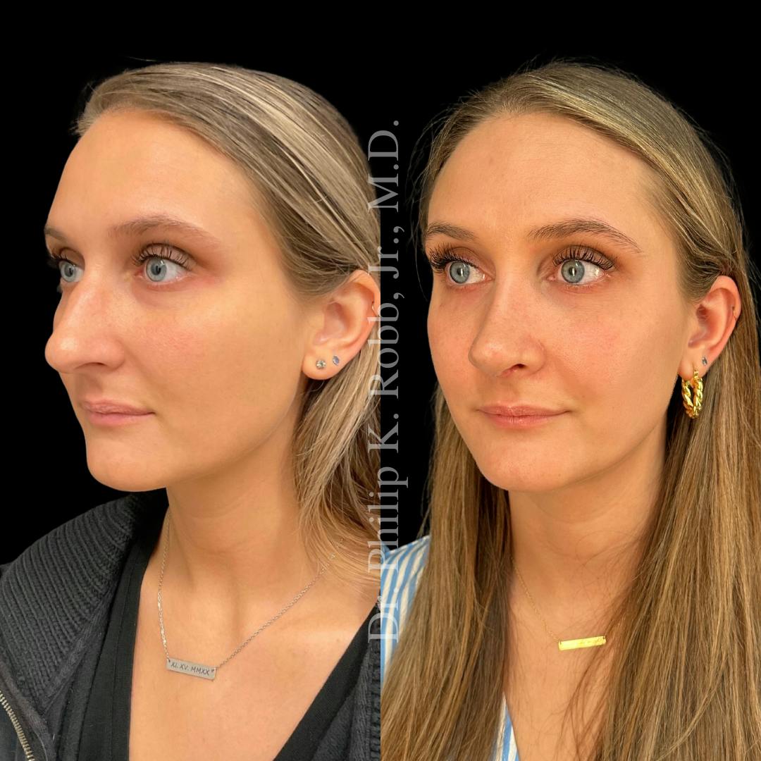 Nose Before & After Gallery - Patient 189960478 - Image 4