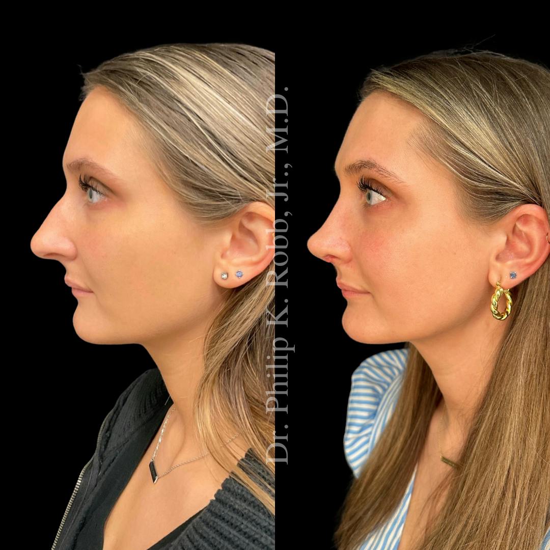 Nose Before & After Gallery - Patient 189960478 - Image 5