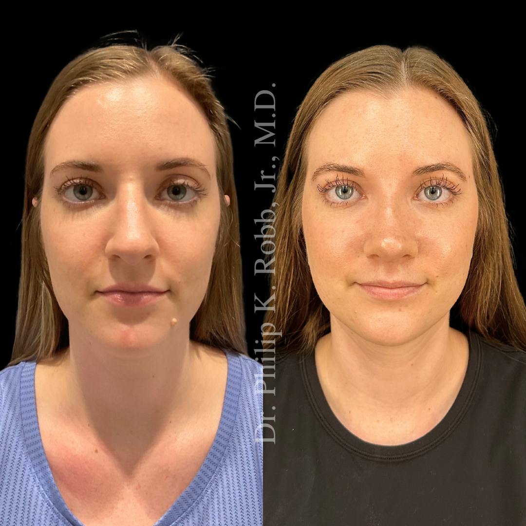Nose Before & After Gallery - Patient 189960481 - Image 2