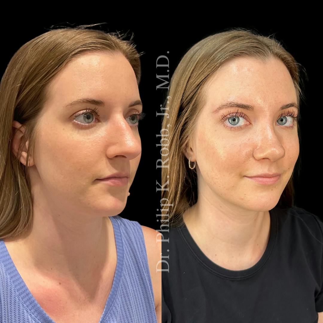 Nose Before & After Gallery - Patient 189960481 - Image 3