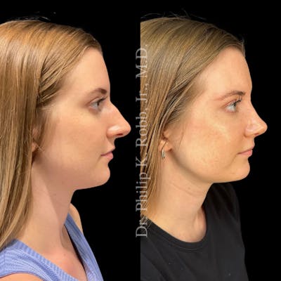 Nose Before & After Gallery - Patient 189960481 - Image 1