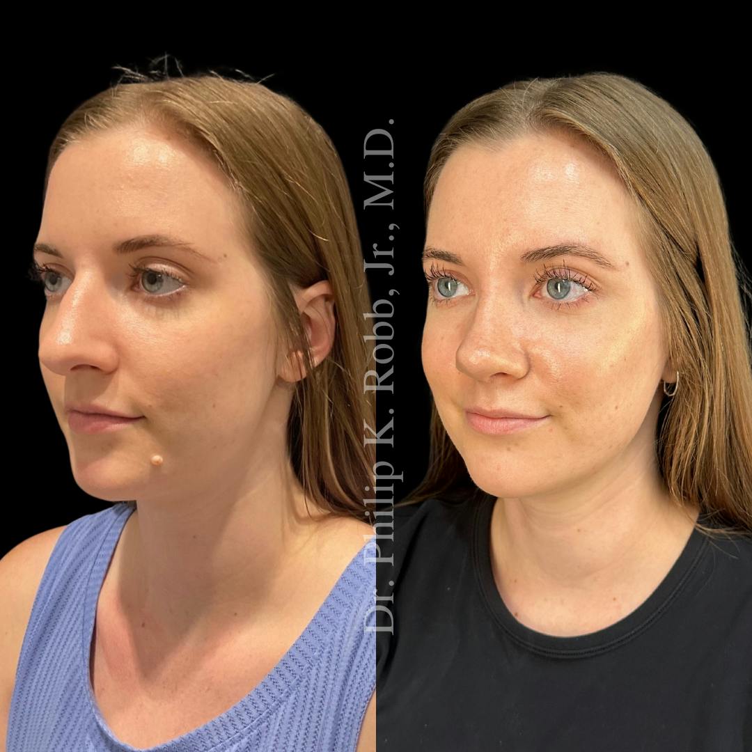 Nose Before & After Gallery - Patient 189960481 - Image 4