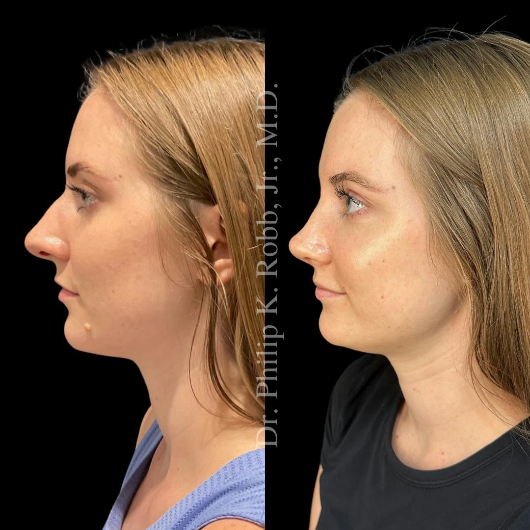Nose Before & After Gallery - Patient 189960481 - Image 5