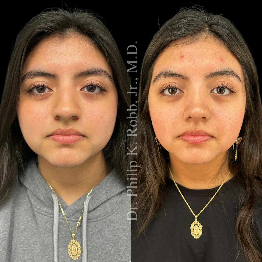 Nose Before & After Gallery - Patient 189960483 - Image 2
