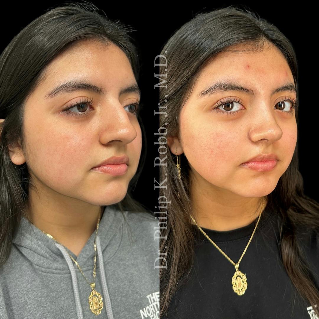 Nose Before & After Gallery - Patient 189960483 - Image 3