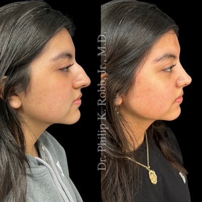 Nose Before & After Gallery - Patient 189960483 - Image 1