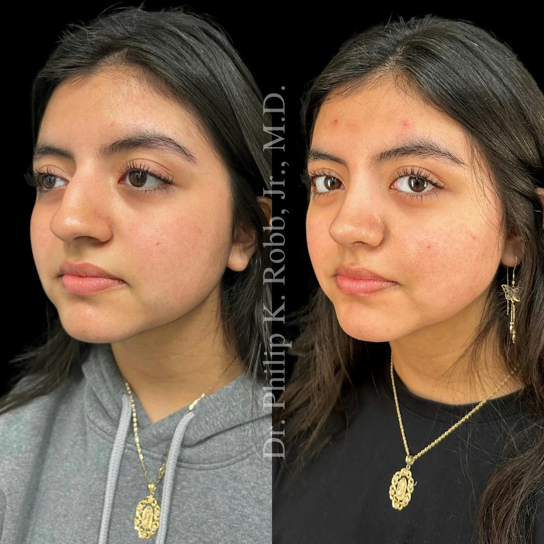 Nose Before & After Gallery - Patient 189960483 - Image 4