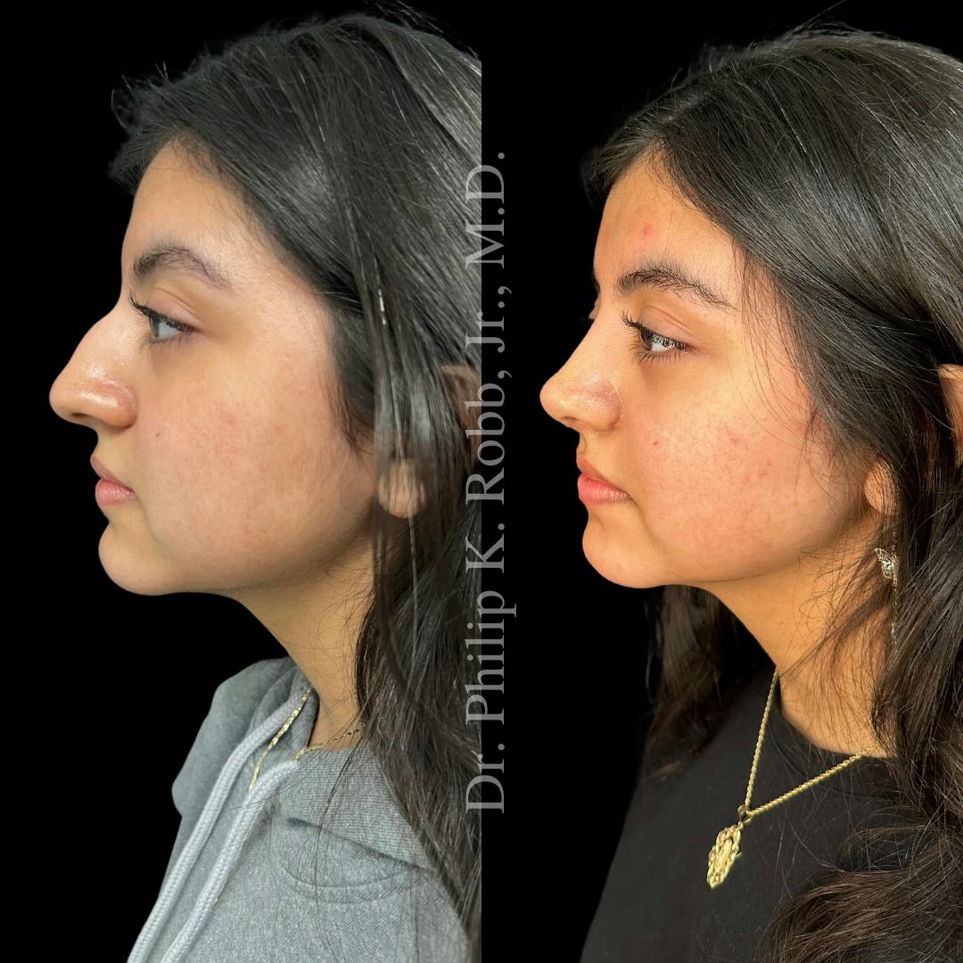 Nose Before & After Gallery - Patient 189960483 - Image 5