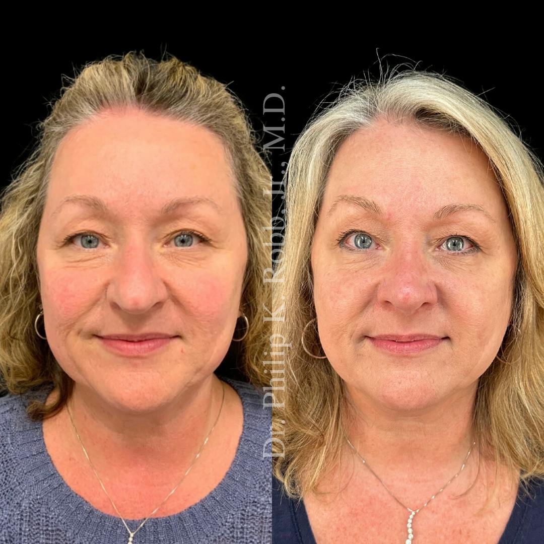 Nose Before & After Gallery - Patient 189960490 - Image 2